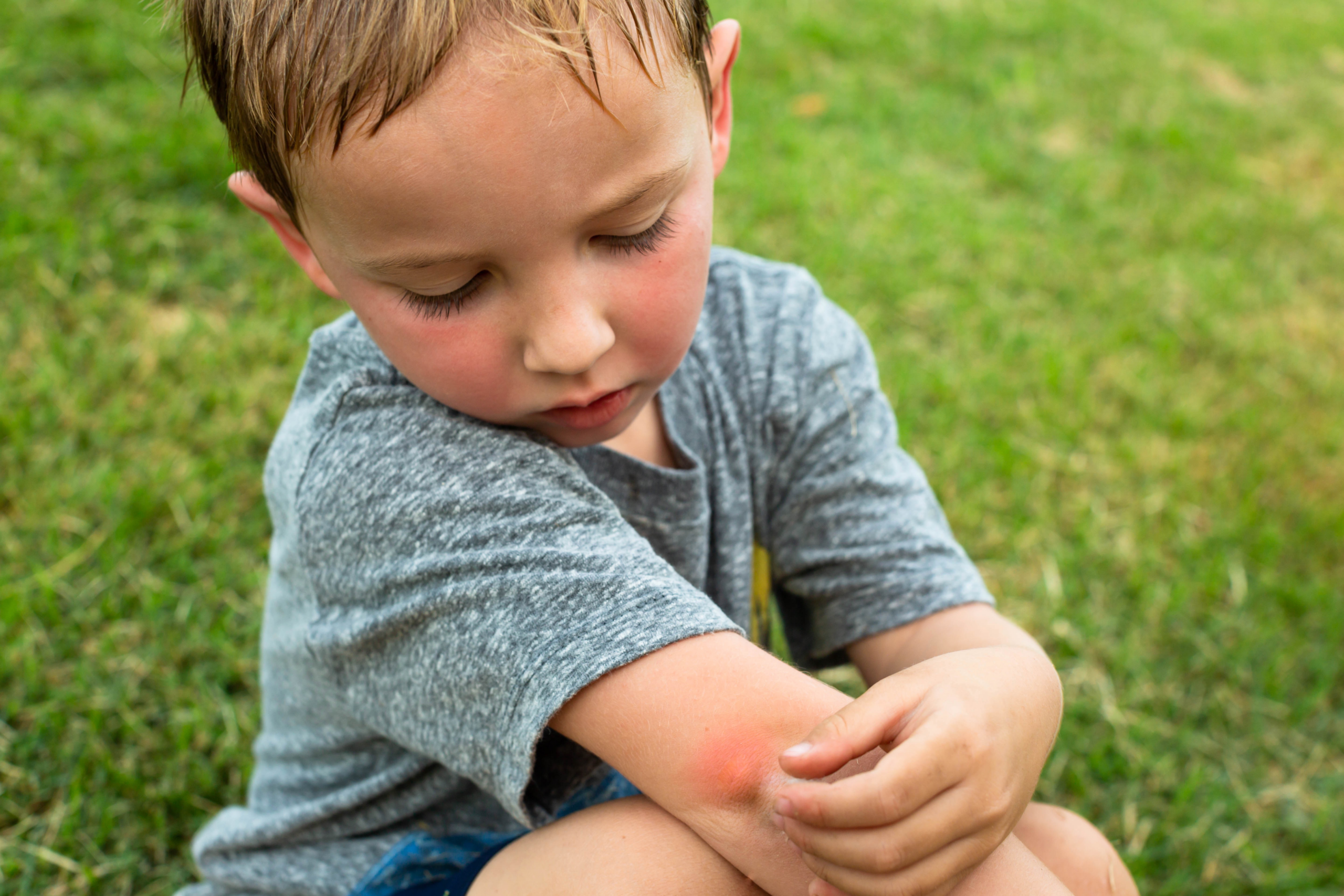 child outside with bug bite